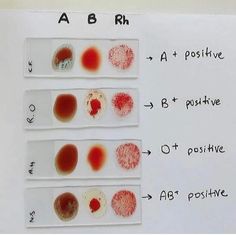 four different types of blood on a white board