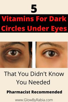 Vitamin deficiencies can lead to dark circles, So what foods should we eat to get rid of dark circles naturally ? Here we will recommend 5 vitamins that can reduce the appearance of dark circles by counteracting the vitamin deficiencies causing them Under eye dark circles| Remedies for dark circles| under eye bags| How to clear dark circles overnight| Under eye bag remedies| dark circles around the eyes| how to remove dark circles under eyes permanently| vitamins for dark circles Eye Dark Circles Remedies, Dark Circle Remedies Overnight, Dark Circles Remedies, Remedies For Dark Circles, Eye Bag Remedies, Remove Eye Wrinkles, Under Eye Dark Circles, Eye Dark Circles, Dark Circle Remedies