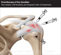 Shoulder Prolotherapy Rotator Cuff Injury Exercises, Rotator Cuff Pain, Injection Sites, Rotator Cuff Surgery, Rotator Cuff Tear