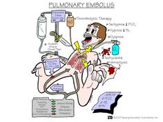 an image of a cartoon character with the words, fulmiary embolus