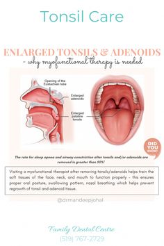 Enlarged Tonsils, Tonsils And Adenoids, Remedies For Dry Mouth, Nasal Breathing, Tongue Thrust, Mouth Hygiene, Mouth Breathing, Myofunctional Therapy, Ear Infections