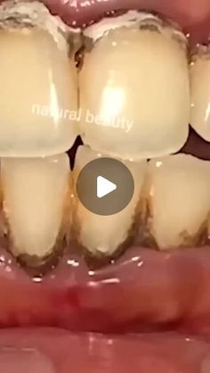 How To Remove Tartar From Teeth, Remove Tartar From Teeth At Home, Teeth Whitening Before And After, Yellow Teeth Remedy, Instant White Teeth, Teeth Makeover, Whiten Teeth At Home, After Wisdom Teeth Removal, Natural Teeth Whitening Diy