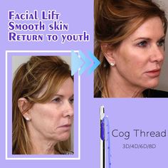 PDO Thread Lift is customized to your individual skin type, skin texture, and aesthetic goals. #Threadlift #faciftsurgery #smooththreads #plasticsurgery #preciousclient #facelift #faceliftthread #facethreadlift #vshapeface Thread Lift, Face Lift, Skin Texture, Skin Type, Plastic Surgery, Smooth Skin