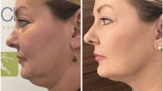 Plastic Surgery Facts, Facial Before And After, Hifu Face, Facelift Before And After, Facelift Procedure, Tighten Facial Skin, Face Lift Surgery