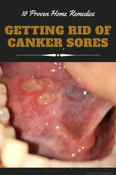 Find out how to get rid of canker sores using home remedies found in your kitchen! Say goodbye to these persistent wounds for good!  #cankersore #cankersoreremedy #howtogetridofcankersore #cankersoreremedytongue ##cankersoreremedymouth #howtogetridofcankersorefast Home Remedy For Mouth Ulcers, Cold Sore Inside Mouth Remedy, Sore Gums Remedy, Canker Sore Remedies, Canker Sore On Tongue, Cold Sore Remedy Overnight, Canker Sore Relief, Ulcer Remedies Mouth