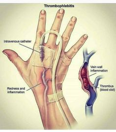 an image of a hand with the wrist spraining and tendor attached to it