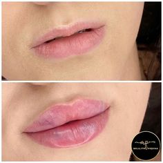 Keyhole Lip Injections, Lip Filler Before And After, Doll Lips, Lip Job, Face Plastic Surgery