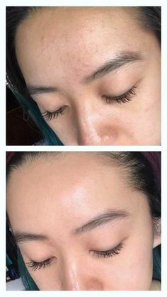 Acne Routine, Fungal Acne, Forehead Acne, Lotion For Oily Skin, Types Of Acne, Japanese Skincare, Moisturizer For Oily Skin, After Photos, Acne Skin