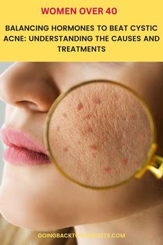 Join us on a journey to understand and conquer hormonal cystic acne. Our post delves into the causes, outlines the symptoms, and guides you through a selection of treatments that blend science and nature for healthier, happier skin. Hormonal Cystic Acne, Thyroid Imbalance, Fungal Acne, Nontoxic Skincare, Heavy Sweating