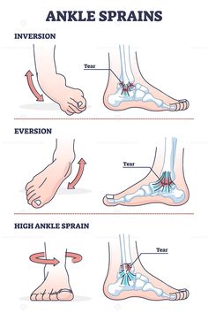 Ankle sprains situations with inversion and eversion injury outline diagram. Twisted foot or leg pain and swollen inflammation cause with bone and ligament xray medical explanation vector illustration #ankle #sprain #foot #pain #leg #commercial #vector #illustration → Get this Illustration for Commercial Use! Tensor Fasciae Latae, Weak Ankles, Dry Needling, Latissimus Dorsi, Trigger Point Therapy, Medical Photos