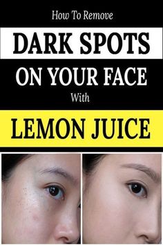 How To Remove Dark Marks From Feet Diy Anti Aging Cream, Dark Spots Remedies, Hormonal Imbalances, Dark Spots On Face, Diy Anti Aging, Brown Spots Removal, Brown Spots On Face, Dark Spots On Skin, Spots On Face