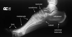 an x - ray view of the foot and ankle with labels on each side of it