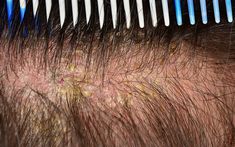 Scalp Eczema: Causes, Symptoms, Treatments & Preventive Tips Exema Treatments For Scalp, Scalp Psiorasis, Scalp Excema, Scaly Scalp, Sores On Scalp, Hair Mask For Dandruff, American Products, Dry Itchy Scalp, Organic Argan Oil