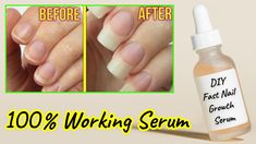 Nail Growth Serum, Nails Grow Faster, Serum At Home, Nail Growth Faster, Sunburn Peeling, Grow Nails Faster, Nail Serum