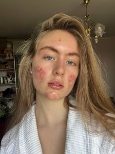 #акне #девушкасакне #девушкаэстетика Acne Aesthetic Girl, Pretty People With Acne, Girls With Acne, Acne Pretty, Acne Girl, Acne Aesthetic, Dark Joke