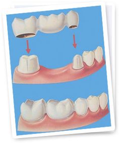 Crowns and Bridges to restore missing teeth Dental Decay, Restorative Dentistry, Missing Teeth