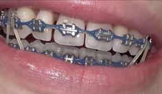 Dark Blue Braces, Light Blue Braces, Grillz Teeth, Brace Face