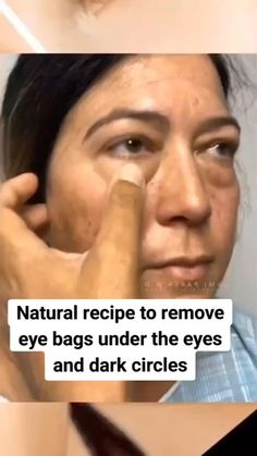 The eyes and dark circles. Leve bags under the eye . If you can’t follow this recipe, comment i need to order and i will send a link on how to order  my best and easiest mixture . Remove Eye Bags, Facial Tips, Wrinkle Remedies, Eye Puffiness, Skin Face Mask, Plastic Vase, Eye Cream For Dark Circles, Healthy Products