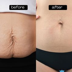 Natural Remedies to Firm Loose Belly Skin Quickly Tighten Loose Belly Skin, Skin Tightening Products, Belly Skin Tightening, Skin Tightening Oils, Tone Belly, Tighten Facial Skin, Skin Tightening Cream, Skin Tightening Treatments, Loose Belly