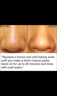 Black Heads, Diy Kosmetik, Health Practices, Herbal Recipes, Mega Hair, Get Rid Of Blackheads, Beauty Tricks, Skin Pores, Beauty Queen