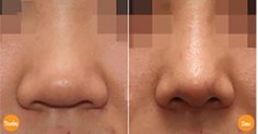 before and after photos of a nose surgery procedure