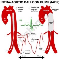 the diagram shows how an intra - aortiic balloon pump is used to treat blood pressure