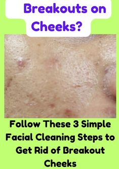 Struggling with breakouts on your cheeks? Discover a simple 3-step facial cleansing routine to clear your skin and prevent future breakouts.
#CheekBreakouts
#FacialCleansing
#ClearSkin
#AcneSolutions
#SkincareRoutine
#AcneHelp
#BeautyTips
#HealthySkin
#AcneTreatment
#DIYSkincare
#PimplePrevention
#NaturalRemedies
#SelfCare
#SkinHealth
#BeautyHacks Breakouts On Cheeks, Cheek Breakouts, Facial Cleansing Routine, Acne Help, Cleansing Routine, Facial Cleaning