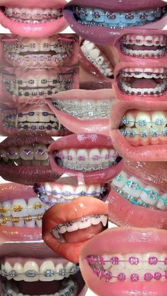 Dark Pink Braces, Baddie With Braces, Braces Combos, Braces Black Women, Pretty Teeth