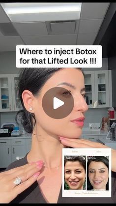 Botox Face Lift Before And After, Botox Eye Lift Before And After, Places To Get Botox On Face, Botox On Jawline, Preventative Botox Before And After, Botox Nose Job, Botox Locations On Face, Facial Botox Areas, Botox Units Needed