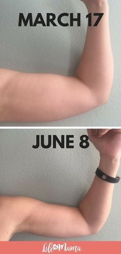 the arm before and after it has been removed