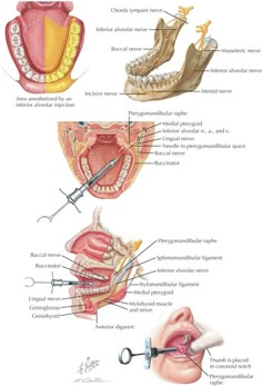 Dental Anesthesia, Dental Hygienist School, Local Anesthesia, Dental Assistant Study, Registered Dental Hygienist, Dental Hygiene Student, Female Dentist, Dental World, Dental Education