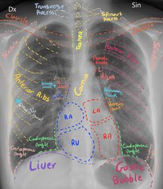 an x - ray shows the location of the lungs in different colors and names on it