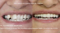 Dentist Doctor, Crooked Teeth, Loose Tooth, Front Teeth, Smile Makeover, Oil Pulling, All Smiles, Bangalore, A Smile