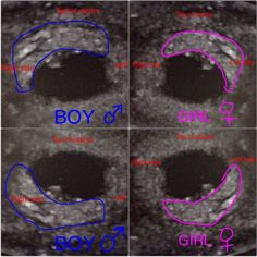 Ramzi Theory, Pregnancy Gender Prediction, Ultrasound Gender, Gender Predictor, 5 Weeks Pregnant, Baby Gender Prediction, Pregnancy Gender, Gender Prediction, Early Pregnancy Signs