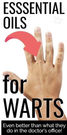 Essential Oils For Warts, Oils For Warts, Warts On Hands, Warts On Face, Home Remedies For Warts, Skin Moles, Skin Growths, Get Rid Of Warts