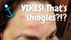 Yikes! That's shingles?!? Advice for Shingles with Diabetes Wonder