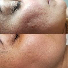 This before and after is after a couple of treatments with the TCA CROSS method for ice pick and box acne scarring. Skin Before And After, Dermapen Before And After, Acne Before And After, Microneedling Before And After, Scar Revision, Botox Before And After, Acne Scarring