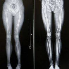 an x - ray image shows the lower legs and upper leg, as well as the top part of the body