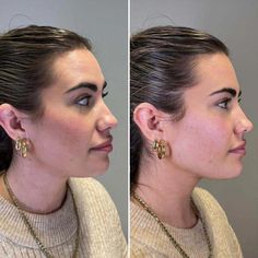 In this guide, we will unpack the ins and outs of jawline Botox before and after what you should know for recovery, and more. Let’s get to it. Good Jawline, Natural Medicine, Medicine, Let It Be