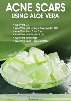 Aloe Vera Diy, Benefits Of, Treating Acne, Treat Acne, Stretch Mark, Hair Treatments, Face Beauty