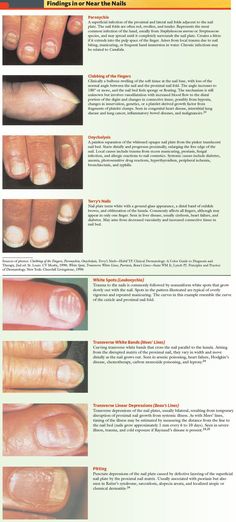 Nail Pathologies Findings in or Near Nails Paronychia A superficial Nail Disorders, Natural Antifungal, Nail Conditions, Nail Fungus Remedy, Health Signs, Tongue Health, Striped Nails, Fungal Infection, Nail Plate