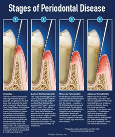 Remedies For Tooth Ache, Dental Check Up, Dental Health Care