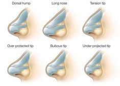 Pimple Inside Nose, Acne On Nose, Nose Surgery Rhinoplasty, Anatomy Head, Nose Types, Nose Reshaping, Rhinoplasty Surgery