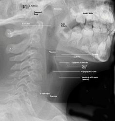 an x - ray shows the teeth and upper part of the mouth, with other parts visible