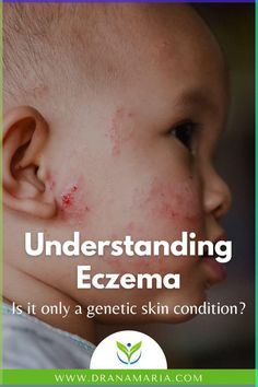 If you google “what causes eczema?”…The typical answers describe an inflammatory skin condition, causing most people to think of eczema as an isolated skin condition. However, Eczema (AKA atopic dermatitis) is a systemic condition that starts in our guts. Learn how you can make the internal changes needed to heal your skin from the inside out! Laser Acne Scar Removal, Acne Scar Removal, Skin Condition, Baby Skin Care, Healthy Skin Care, Health Advice, Skin Tips, Genetic, Healthy Kids