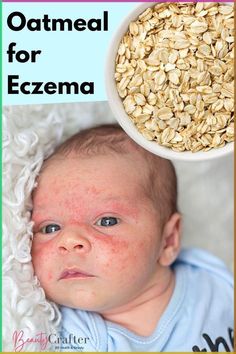 Oatmeal is a great natural remedy for eczema outbreaks and it is safe for baby. Learn more about the benefits of oats in treatment and how to use colliodal oatmeal to soothe eczema related skin inflammation. Benefits Of Oats, Skin Detox, Essential Oils For Skin, Cruelty Free Skin Care, Natural Remedy, Diy Health