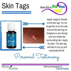 . Essential Oils For Skin Tags, Skin Tags Essential Oils, Essential Oil For Skin, Remove Skin Tags, Remove Skin Tags Naturally, Homemade Body Care, Oregano Essential Oil