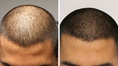 Hair Tattoo, Male Pattern Baldness, Hair Patterns, Pattern Baldness