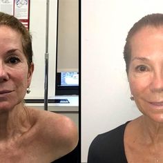 Kathie Lee Gifford reveals the laser skin treatment that helps her keep a youthful look Face Laser, Kathie Lee Gifford, Skin Care Treatments, Face Skin Care