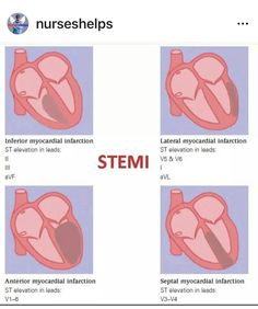 four different stages of the heart